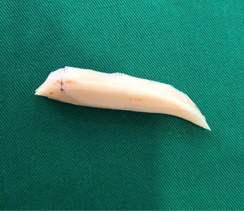 Từ câu chuyện lòi vách ngăn đầu mũi của cô gái trẻ, bác sĩ chỉ ra điều cần khắc cốt ghi tâm trong ăn uống khi nâng mũi làm đẹp-5