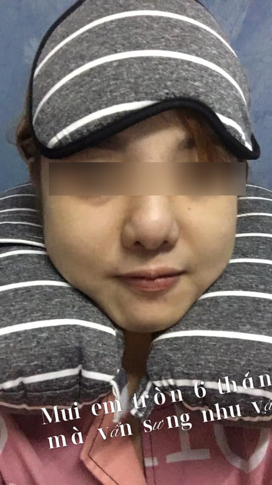 Từ câu chuyện lòi vách ngăn đầu mũi của cô gái trẻ, bác sĩ chỉ ra điều cần khắc cốt ghi tâm trong ăn uống khi nâng mũi làm đẹp-7