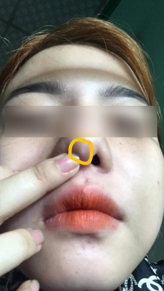 Từ câu chuyện lòi vách ngăn đầu mũi của cô gái trẻ, bác sĩ chỉ ra điều cần khắc cốt ghi tâm trong ăn uống khi nâng mũi làm đẹp-8