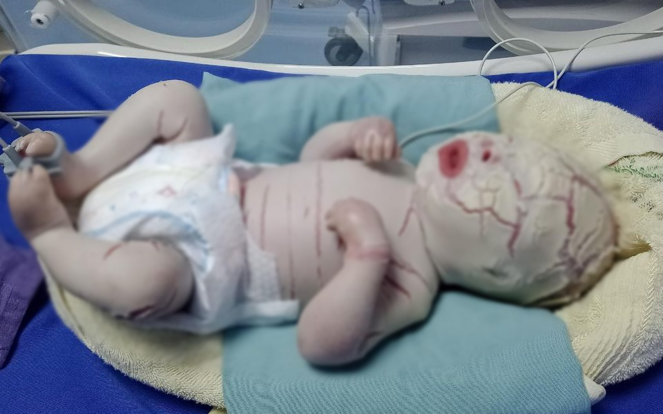 Hiếm gặp: Mắc bệnh lý rối loạn da di truyền, một trẻ sơ sinh có da toàn thân bị khô cứng-2