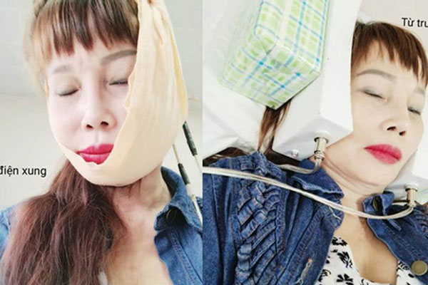 Cô dâu Thu Sao tiếp tục gây choáng váng với nhan sắc lạ mặc dù đang điều trị méo miệng-5