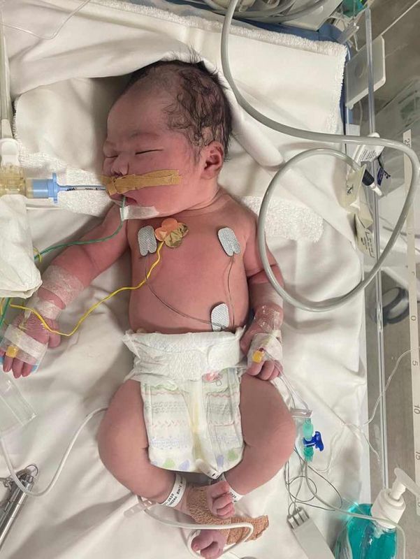 Vỡ ối một ngày nhưng tử cung chỉ mở 3 phân, bà mẹ vẫn kiên định chờ sinh thường khiến tim thai ngừng đập-1