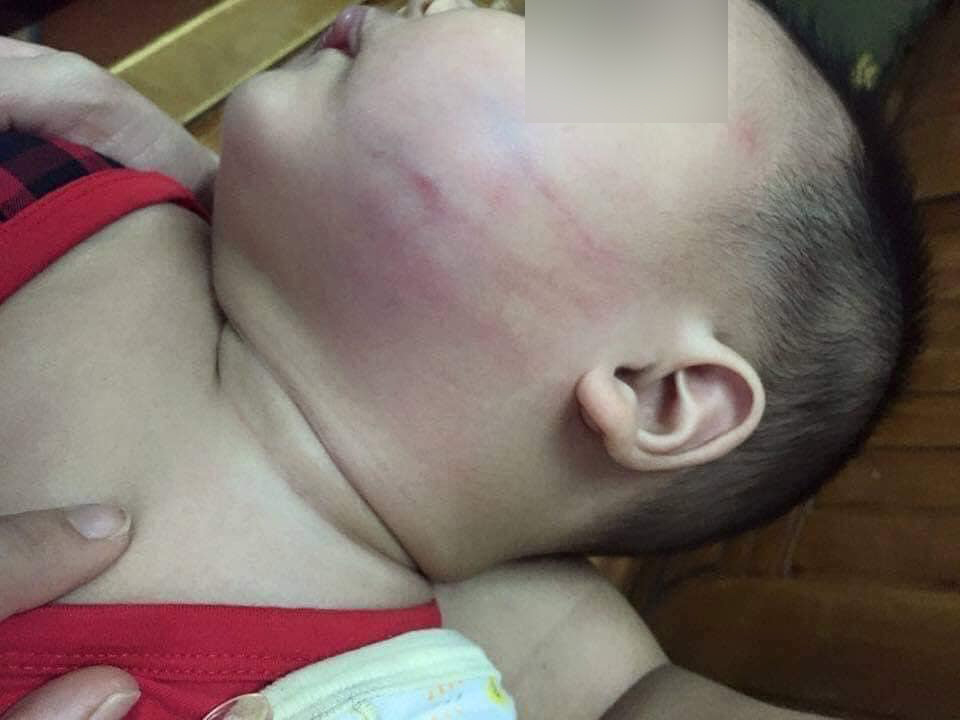 Xôn xao vụ việc bé trai 8 tháng tuổi đi nhà trẻ về bầm tím một bên má, mẹ vừa trông thấy mặt con liền ngất xỉu ngay tại chỗ-2