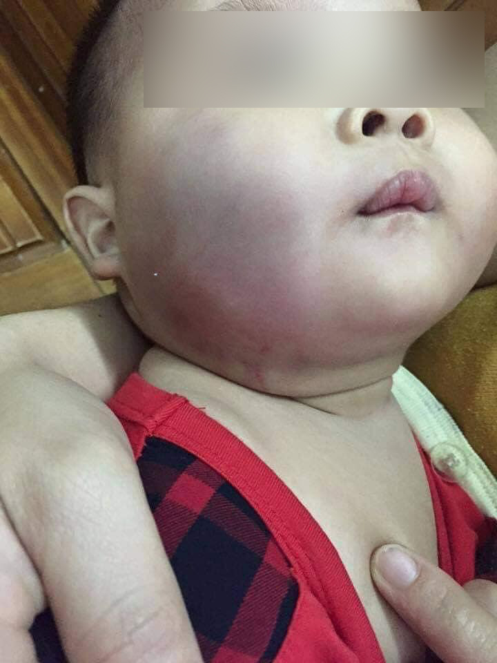 Xôn xao vụ việc bé trai 8 tháng tuổi đi nhà trẻ về bầm tím một bên má, mẹ vừa trông thấy mặt con liền ngất xỉu ngay tại chỗ-1