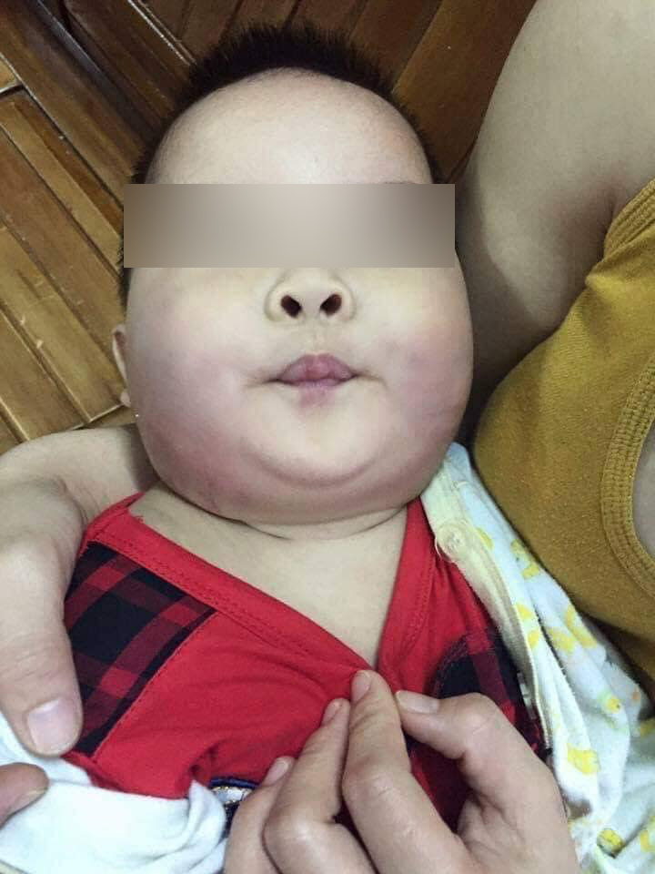 Xôn xao vụ việc bé trai 8 tháng tuổi đi nhà trẻ về bầm tím một bên má, mẹ vừa trông thấy mặt con liền ngất xỉu ngay tại chỗ-3