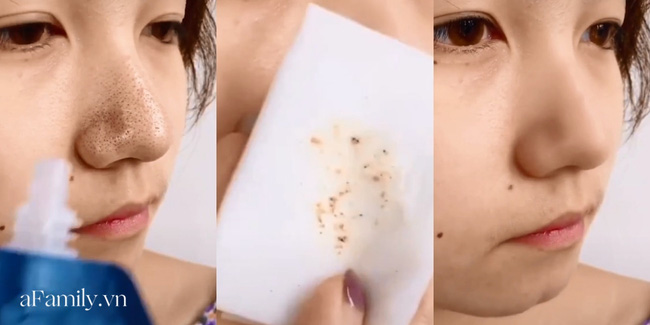 Hết hồn với loại mặt nạ quét sạch mụn: Bác sĩ da liễu cạn lời không hiểu lý do gì có thể cà mịn lỗ chân lông như thế-3