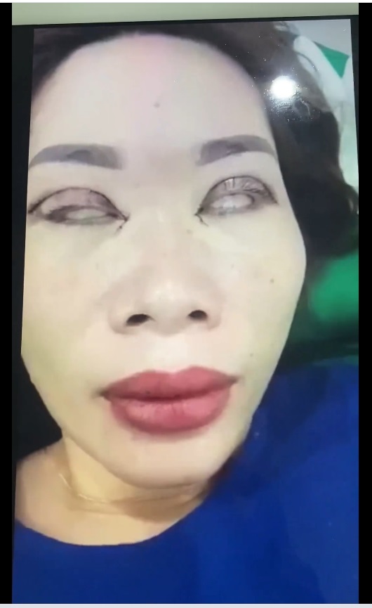 Pha cắt mí đi vào lòng đất: Dân mạng gọi đó là chết không nhắm được mắt-2