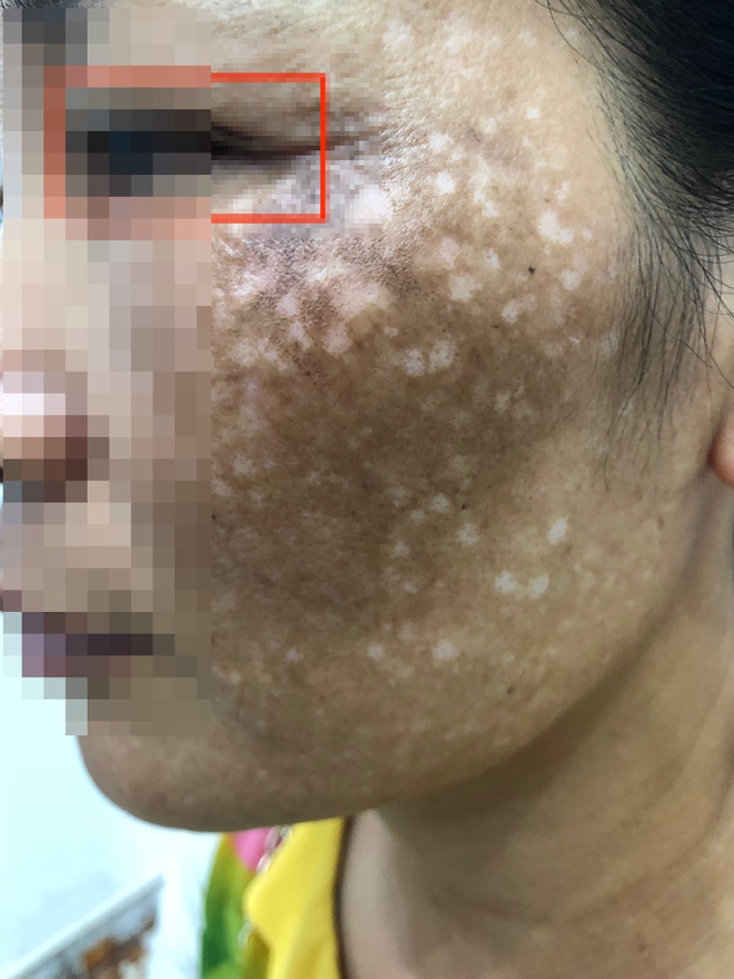 Người phụ nữ nhập viện sau khi chi 500 triệu đồng trị nám-1