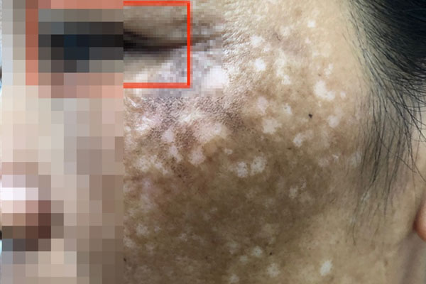 Trị nám da không đúng cách, nhiều chị em phải trả giá bằng... cả khuôn mặt-2