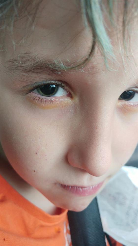 Bé trai 9 tuổi bị mù vĩnh viễn sau khi chiếu tia sáng từ một món đồ chơi vào mắt 2 giây-1