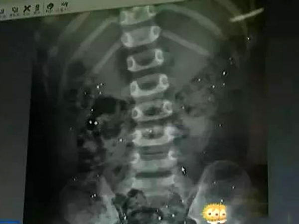 Bé trai 3 tuổi cắn vỡ nhiệt kế thủy ngân, bố mẹ rùng mình khi nhìn phim chụp X-quang-1