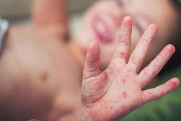 Bệnh viện ở TP.HCM đông nghẹt trẻ bị tay chân miệng-9