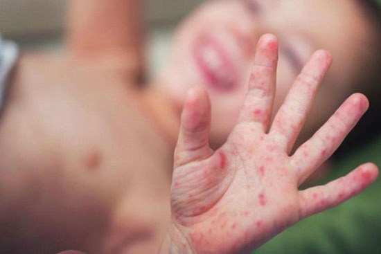 Hàng nghìn trẻ mắc tay chân miệng, nhiều ca biến chứng nặng lên não