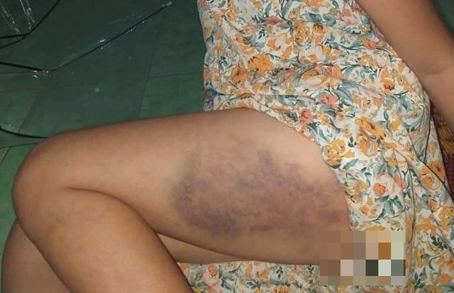 Không mang theo dụng cụ học tập và không làm được bài, bé gái lớp 3 bị cô giáo lấy thước đánh tím bầm một bên đùi để cho tiến bộ-2