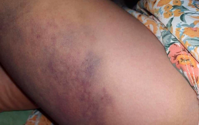 Không mang theo dụng cụ học tập và không làm được bài, bé gái lớp 3 bị cô giáo lấy thước đánh tím bầm một bên đùi để cho tiến bộ-1