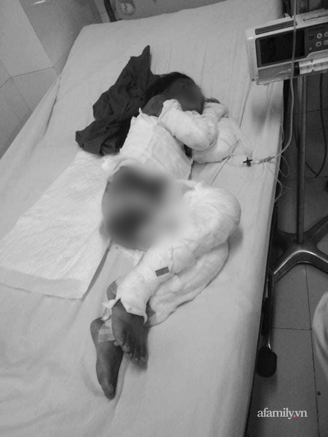 Đang ăn cơm, bé gái lớp 2 biến thành ngọn đuốc sống do xăng dầu bố mẹ trữ trong nhà đổ vào bếp bùng cháy-1