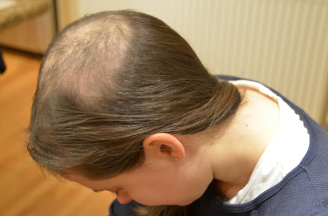 Con gái liên tục tự nhổ tóc mỗi ngày, 15 tuổi đã hói cả đầu, mẹ đưa đi khám mới tá hóa phát hiện sự thật-3