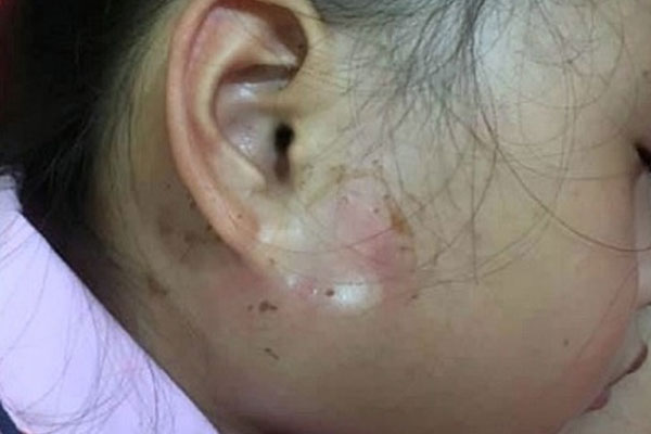 2 trường hợp trẻ nhỏ bị áp xe viêm thành ổ mủ vì người nhà chữa bệnh theo cách được hàng xóm mách-1