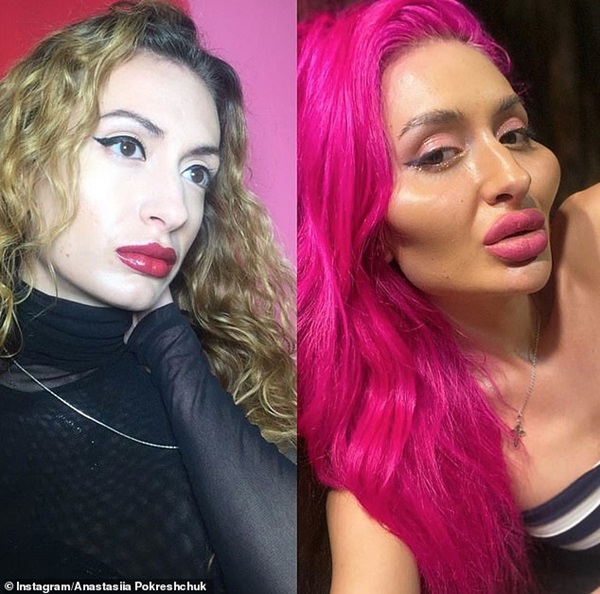 Bỏ gần 5 chục triệu tự tiêm filler, người mẫu Instagram có đôi má bự nhất thế giới bảo vẫn nhỏ lắm chưa ăn thua-2