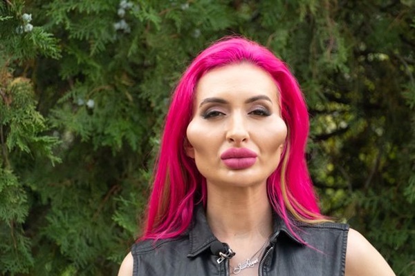 Bỏ gần 5 chục triệu tự tiêm filler, người mẫu Instagram có đôi má bự nhất thế giới bảo vẫn nhỏ lắm chưa ăn thua-3