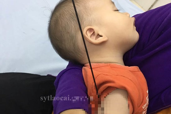 Nan ô đâm xuyên cánh tay bé 6 tháng tuổi