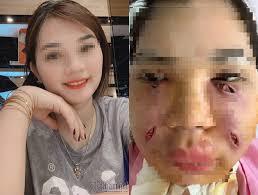 Tiêm mỡ tự thân làm đẹp, cô gái Hà Thành phải rạch mặt sưng nề để nặn ổ mủ-1
