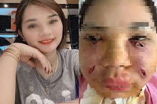Tiêm mỡ tự thân làm đẹp, cô gái Hà Thành phải rạch mặt sưng nề để nặn ổ mủ