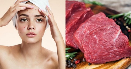 Nếu không muốn bị chê kém xinh, các chị hãy thuộc nằm lòng đáp án cho câu hỏi kiêng ăn gì để không bị sẹo thâm-3