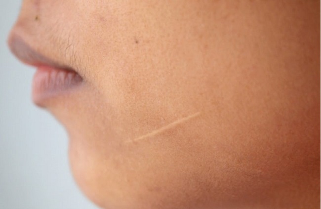 Nếu không muốn bị chê kém xinh, các chị hãy thuộc nằm lòng đáp án cho câu hỏi kiêng ăn gì để không bị sẹo thâm-8