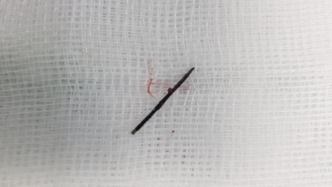 Bé gái 3 tuổi bị sốt cao liên tục, đi khám thì phát hiện chiếc kim khâu dài 17mm trong cột sống-1