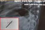 Bé trai nguy kịch tính mạng sau 3 ngày sốt cao-2