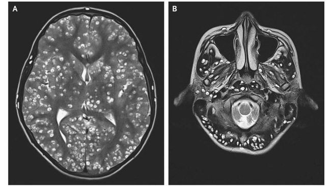 Phát hiện cục u trong não người phụ nữ, bác sĩ quyết định phẫu thuật thì ngỡ ngàng trước vật thể thực sự bên trong và chỉ ra món ăn khiến cô suýt mất mạng-2