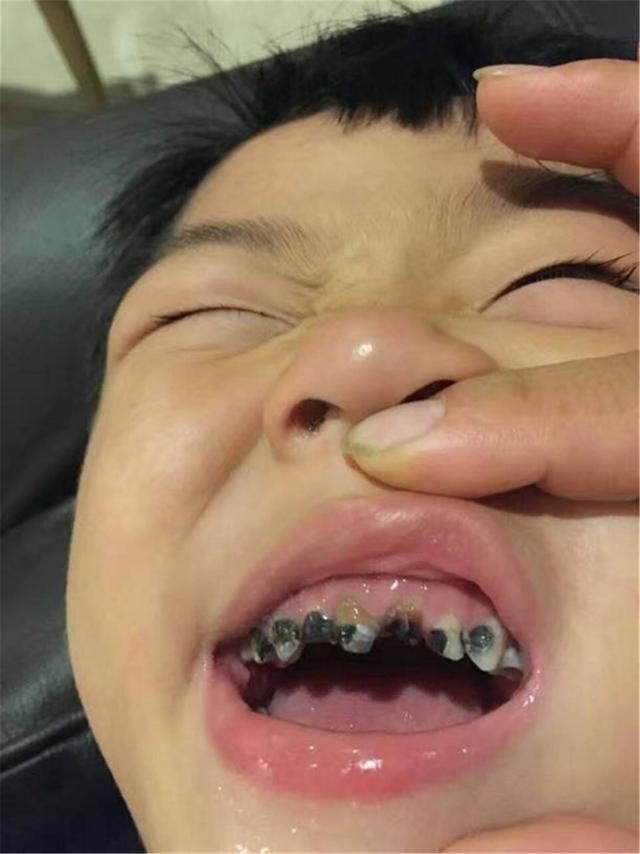 Bé 3 tuổi bị cô lập trong trường mẫu giáo vì miệng đầy những chiếc răng nhỏ màu đen, mẹ muốn chờ thay răng nhưng bác sĩ đã giận dữ-2