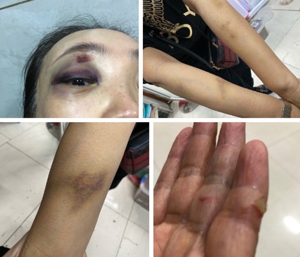 Vợ VĐV điền kinh nổi tiếng tố chồng ngoại tình và bạo hành gia đình, người chồng bình thản trả lời: VĐV đều như vậy, do hormone nam quá cao-5