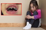 Bé 3 tuổi bị cô lập trong trường mẫu giáo vì miệng đầy những chiếc răng nhỏ màu đen, mẹ muốn chờ thay răng nhưng bác sĩ đã giận dữ