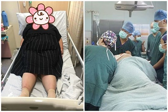 Khổ sở vạch lớp mỡ dày mổ đẻ cho 9X 