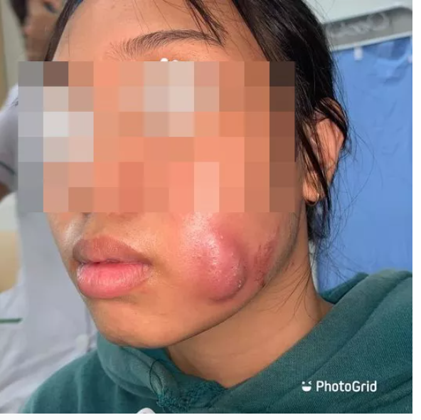 Đi làm đôi má lúm đồng tiền cho duyên dáng, cô gái 16 tuổi bị nhiễm trùng nặng, áp xe tạo ổ mủ lớn ở má-1