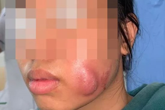 Đi làm đôi má lúm đồng tiền cho duyên dáng, cô gái 16 tuổi bị nhiễm trùng nặng, áp xe tạo ổ mủ lớn ở má