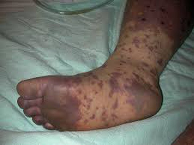 Bệnh lây qua đường tình dục hiếm gặp xuất hiện tại Việt Nam-1