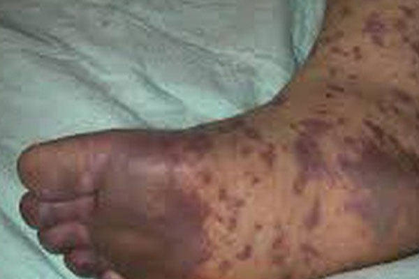 Quan hệ tình dục không an toàn, bạn có nguy cơ mắc bệnh gì?-2