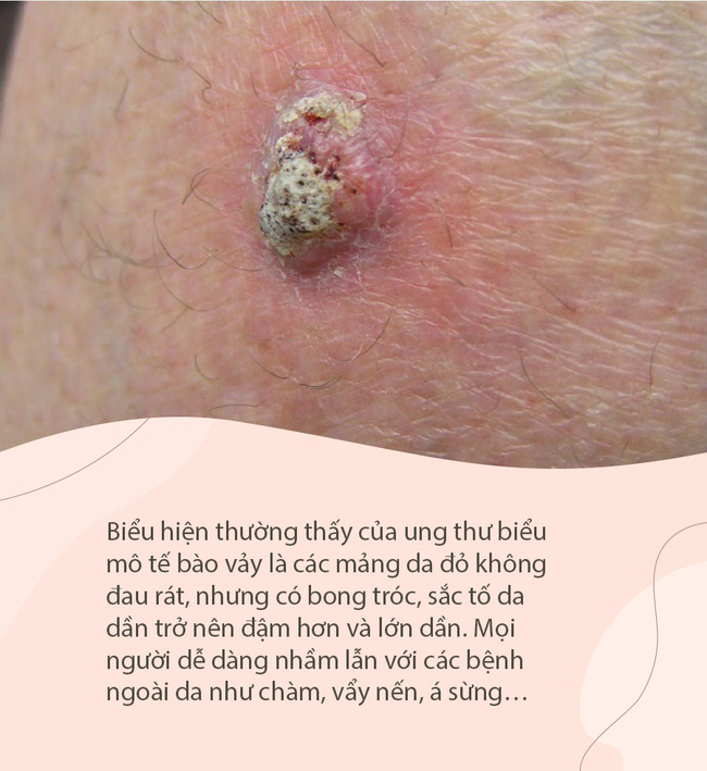 Vết bớt này ban đầu không đau, không ngứa, nhưng 4 tháng sau người phụ nữ được chẩn đoán mắc bệnh ung thư nguy hiểm bậc nhất-2
