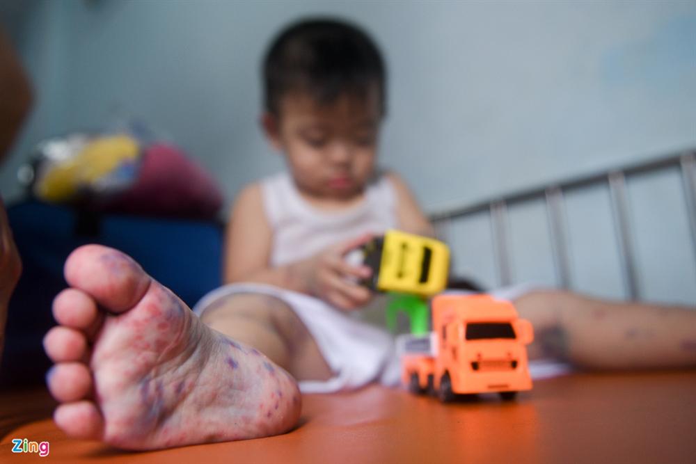 Bệnh viện ở TP.HCM đông nghẹt trẻ bị tay chân miệng-7