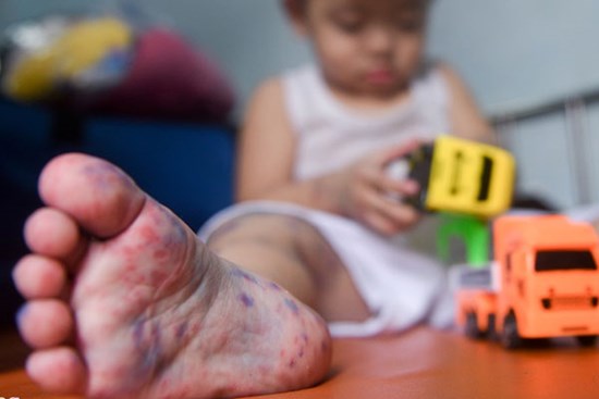 Bệnh viện ở TP.HCM đông nghẹt trẻ bị tay chân miệng