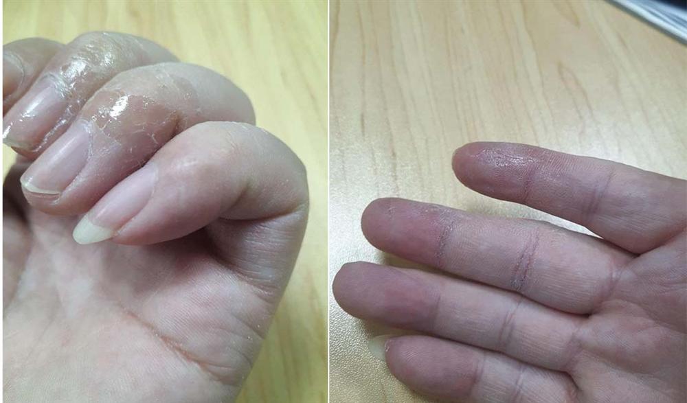 Mẹo khắc phục sự cố chẳng may bị dính keo 502 vào ngón tay-5