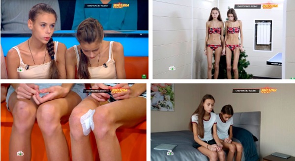 Nghe lời công ty người mẫu mách nhịn ăn để xương gò má lộ ra mới đẹp, cặp song sinh chỉ còn da bọc xương nằm chờ chết và cái kết không ngờ-10