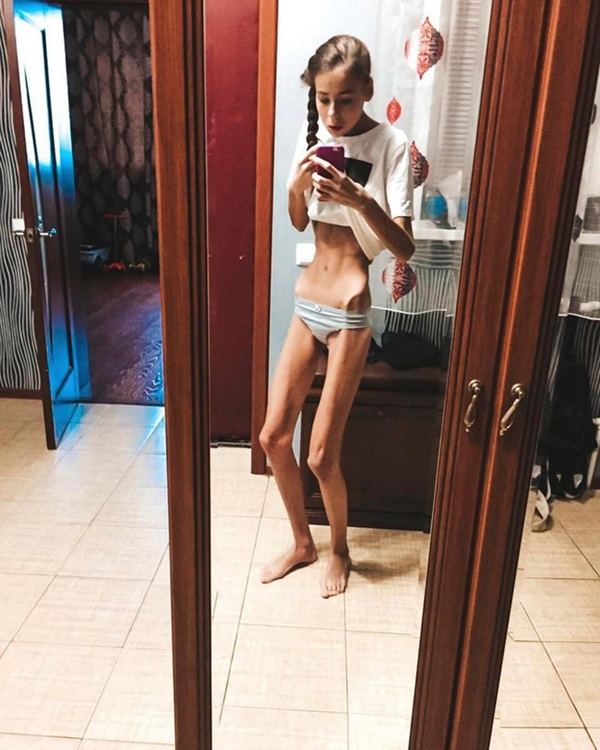 Nghe lời công ty người mẫu mách nhịn ăn để xương gò má lộ ra mới đẹp, cặp song sinh chỉ còn da bọc xương nằm chờ chết và cái kết không ngờ-6