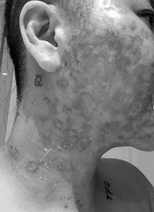 Đầu tư tiền làm trẻ hóa căng da, người phụ nữ bị bỏng rộp hết khuôn mặt-6