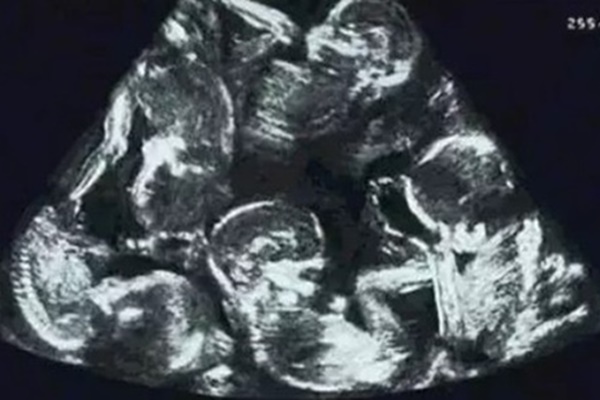 Định sinh thêm 1 con rồi chốt sổ, bà mẹ choáng váng khi đi siêu âm ở lần mang thai thứ 2-7