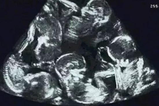 Siêu âm ở tuần thứ 6, bác sĩ thông báo một tin khiến bà mẹ run lẩy bẩy, sau đó ngồi khóc suốt 1 giờ đồng hồ