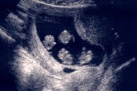 Định sinh thêm 1 con rồi 'chốt sổ', bà mẹ choáng váng khi đi siêu âm ở lần mang thai thứ 2